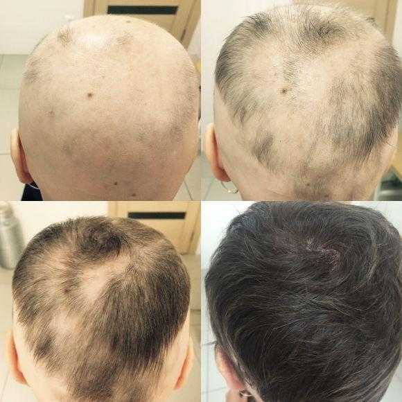 Атрофическая алопеция – самая редкая форма выпадения волос