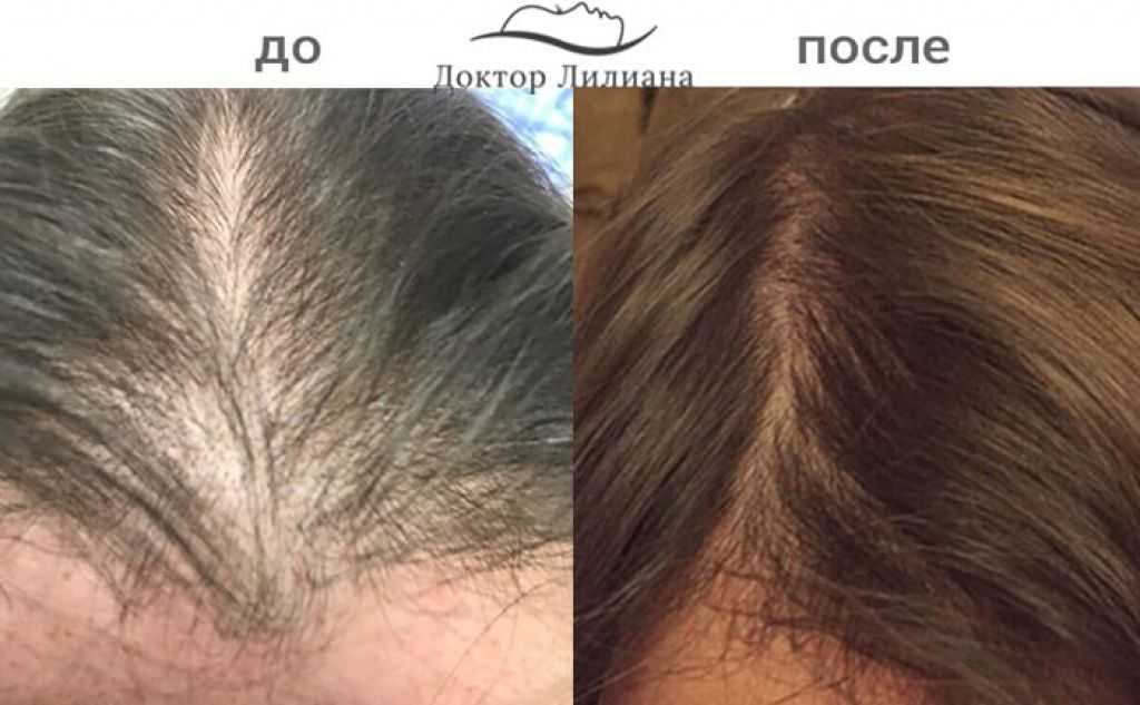 Если восстановить гормональный фон волосы перестают расти
