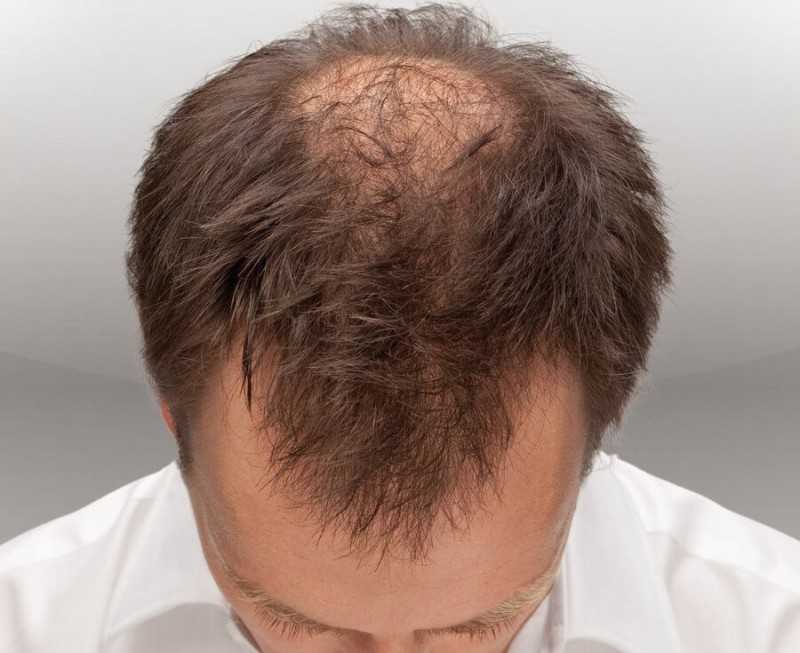 Причины появления седых волос. связь с генетикой и раннее поседение