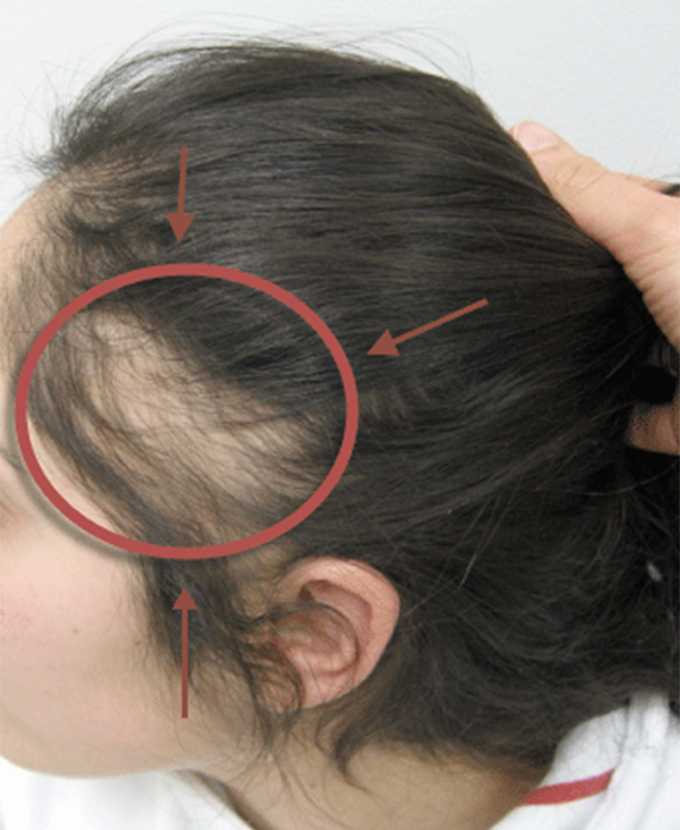 Очаговое выпадение волос: причины, лечение, профилактика