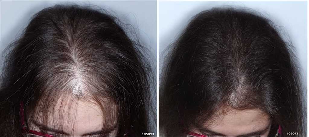 Выпадение волос весной у мужчин и женщин – причины и лечение сезонного выпадения волос