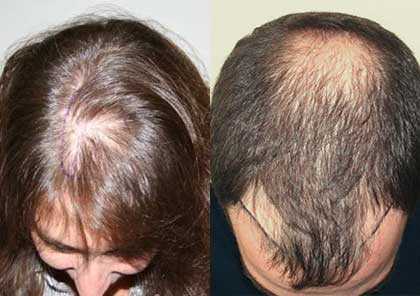Миноксидил – безусловный активатор роста волос