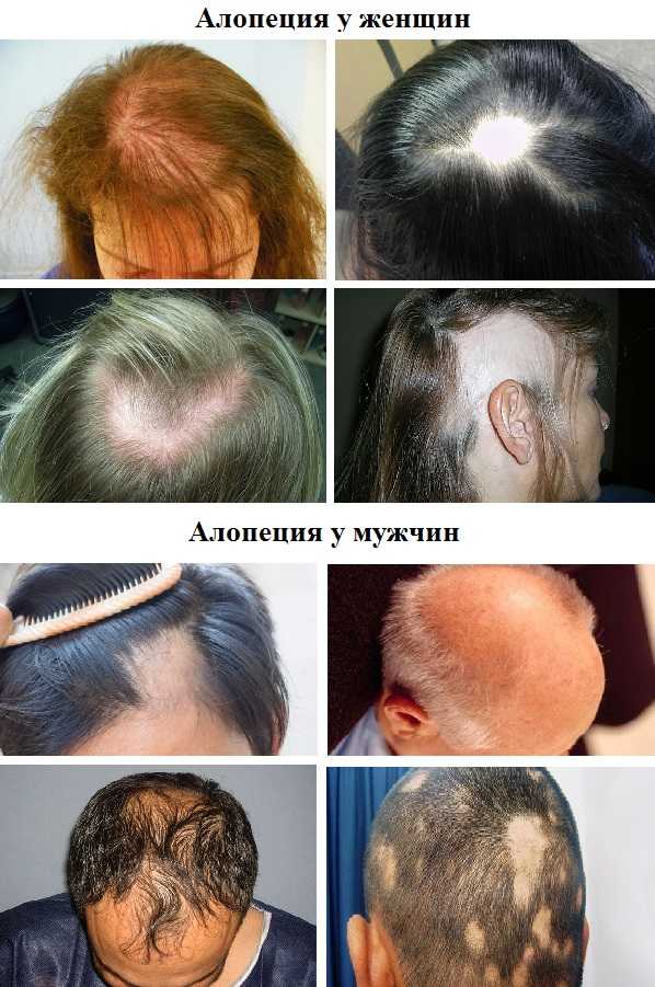 Тракционная алопеция или как тугие прически влияют на выпадение волос