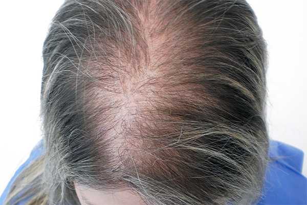 Старение волос: геронтобиология волосяного фолликула :: овчаренко юлия