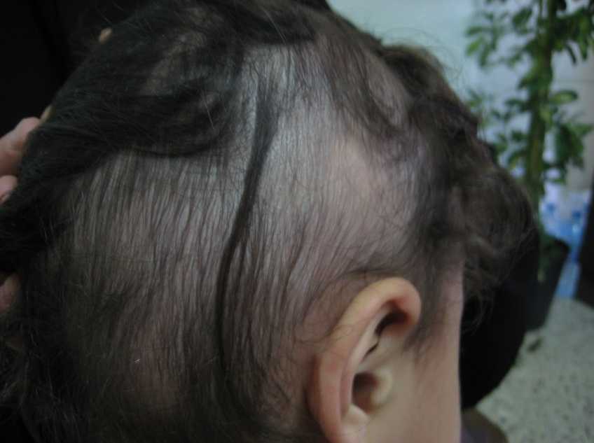 К кому обращаться при выпадении волос у ребенка