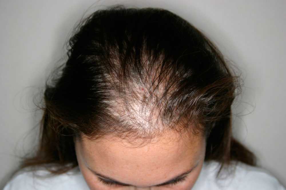 Выпадение волос после коронавируса, лечение волос после ковида