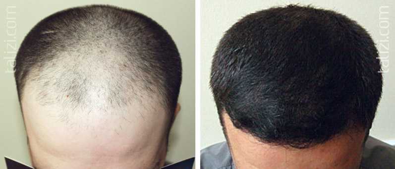 Глазирование волос в домашних условиях: процедура шелкового глазирования волос, отзывы, до и после