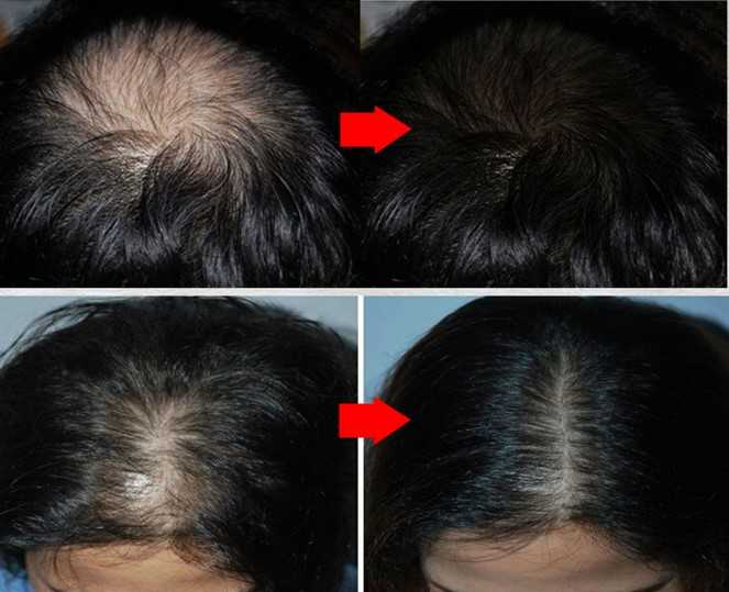Редеющие волосы у женщин: причины, лечение, профилактика