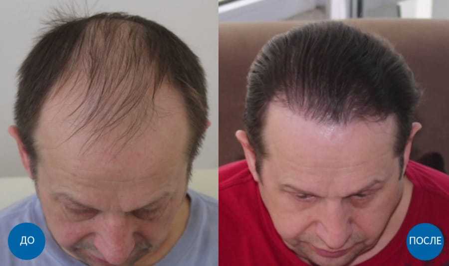 Пересадка волос в область бровей