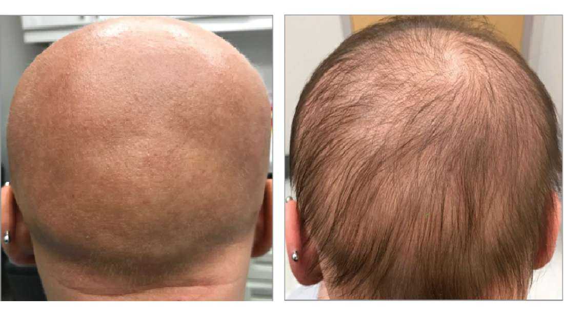 Тракционная алопеция или как тугие прически влияют на выпадение волос