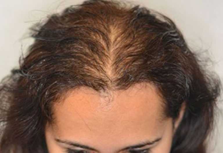 Что делать если выпадают волосы? определение причин и лечение