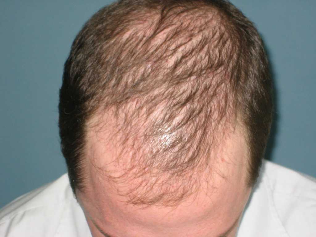 ▷ помогает ли шампунь против выпадения волос? - clinicana
