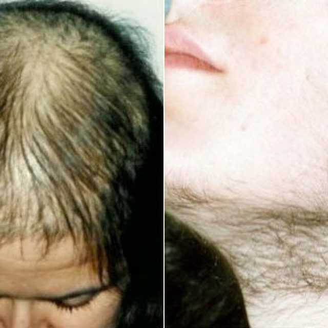 Диксон полипант — ампулы от выпадения и для роста волос