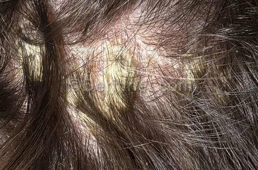 Перхоть в бровях - клиника «доктор волос»