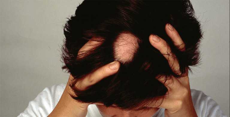 Какие заболевания провоцируют выпадение волос у женщин