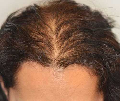 Выпадают волосы у женщины: что делать? – публикации – лаборатория ан-тек