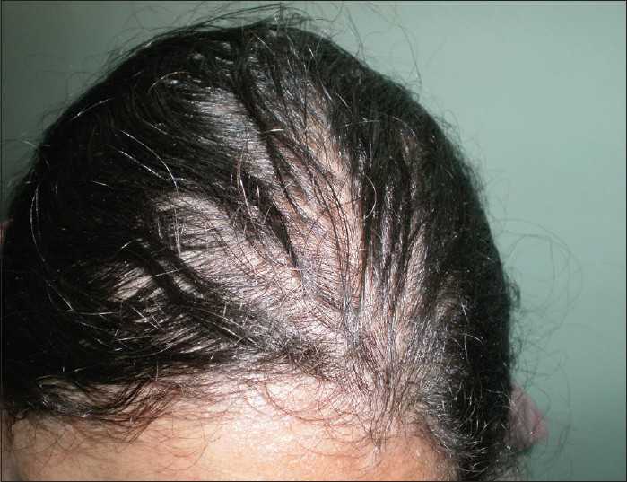 В каком возрасте должна появляться первая седина Причины появления седых волос Почему люди начинают седеть в молодом возрасте Различные виды лечения: медикаментозное, народные средства Профилактика ранней седины