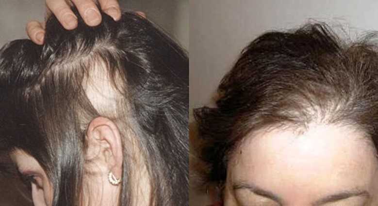 Выпадение волос бровей: основные причины, и как с этим можно бороться