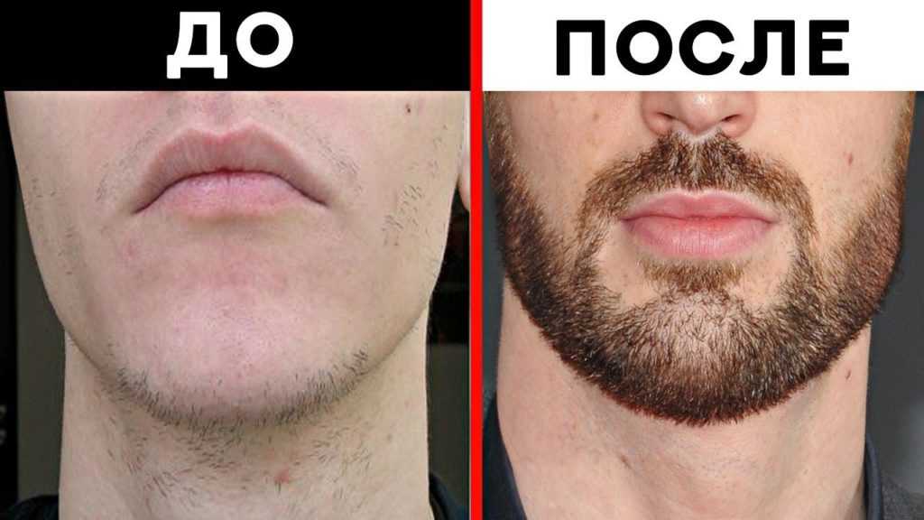 Обзор лучших средств для роста бороды: чем мазать щетину, чтобы росла быстрее
