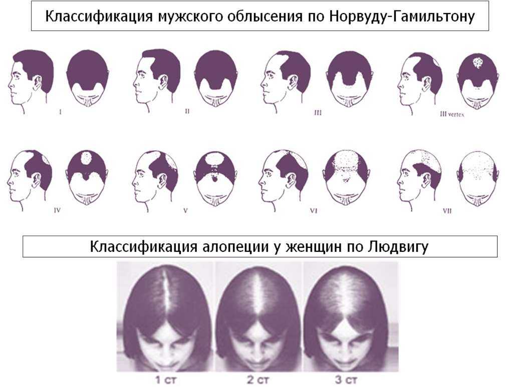 Выпадение волос по женскому типу тип i по людвигу