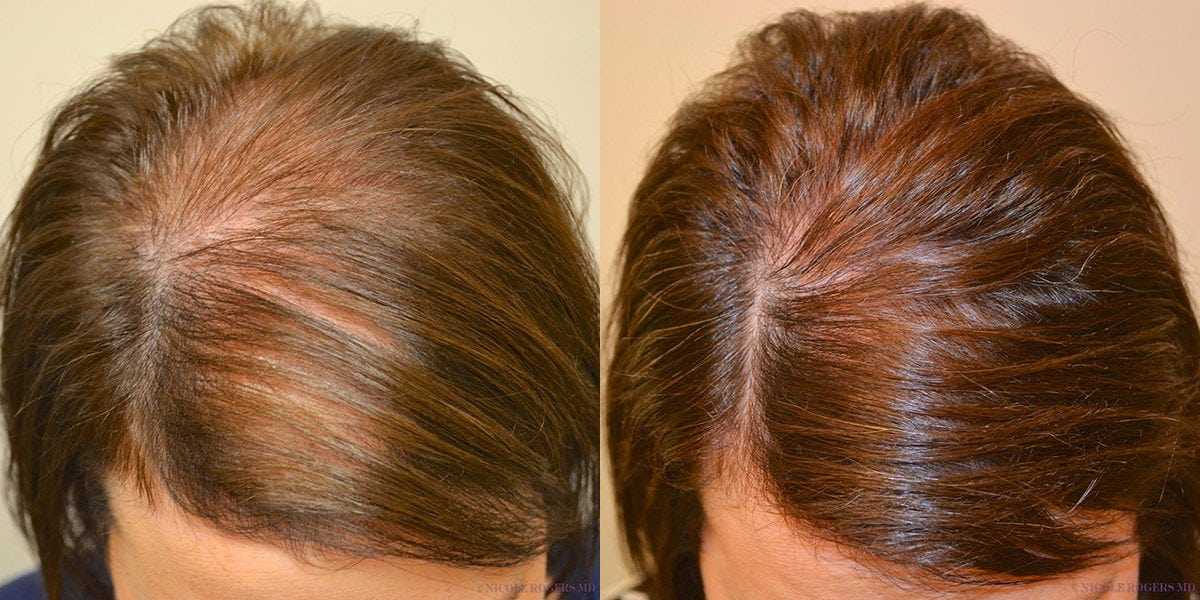 Лечение жирных волос - причины и средства лечения жирных волос