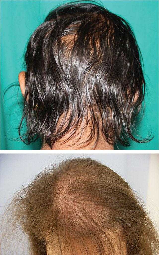 Аллергия на краску для волос - симптомы и лечение аллергии после краски для волос
