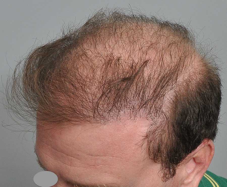 Сочетанное применение транскраниальной электростимуляции и наружного препарата, стимулирующего рост волос и обладающего противовоспалительным действием, в лечении гнездной алопеции