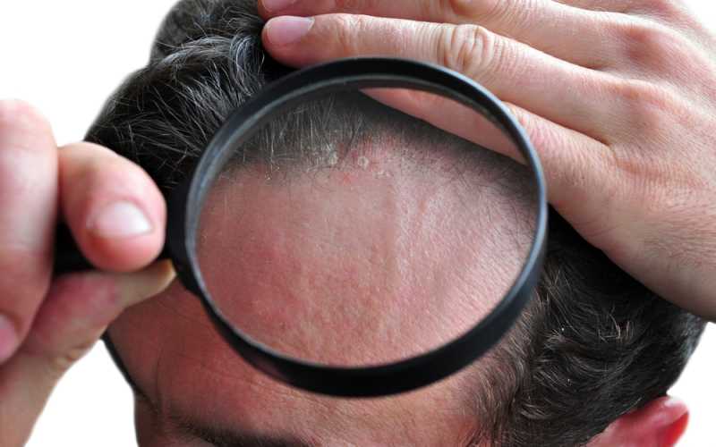Грибок кожи головы – симптомы, лечение – как вылечить