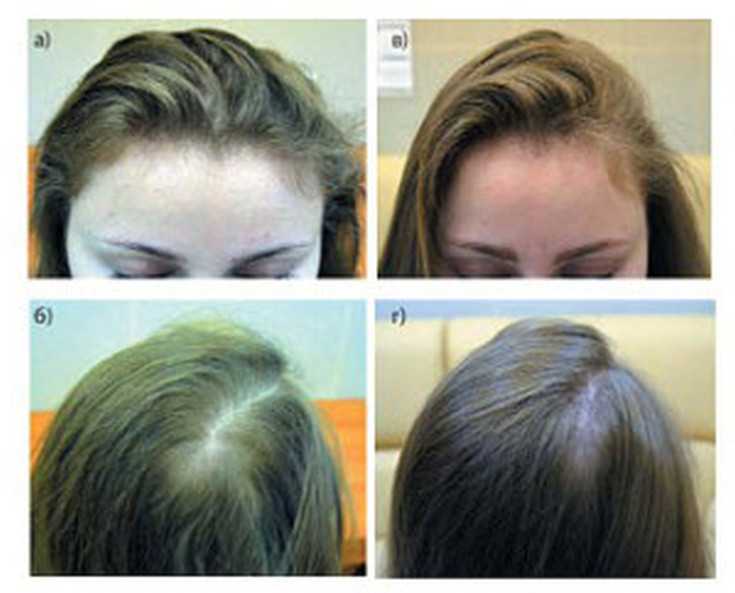Барнаульский дерматолог рассказала о массивном выпадении волос после коронавируса