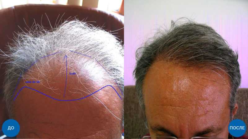В каких случаях пересадка волос противопоказана взрослым людям