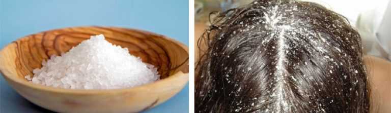 Жирная перхоть : причины, профилактика, лечение | средства для волос alerana