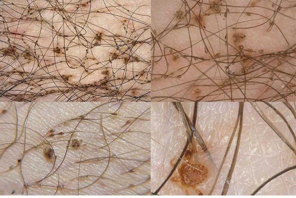 Можно ли утюжком для волос убить гнид – как уничтожить паразитов плойкой и феном, другие популярные способы