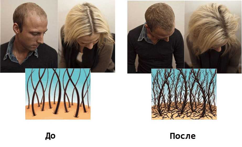 Как проходит процедура пересадки волос методом hfe - трансплантация волос hfe
