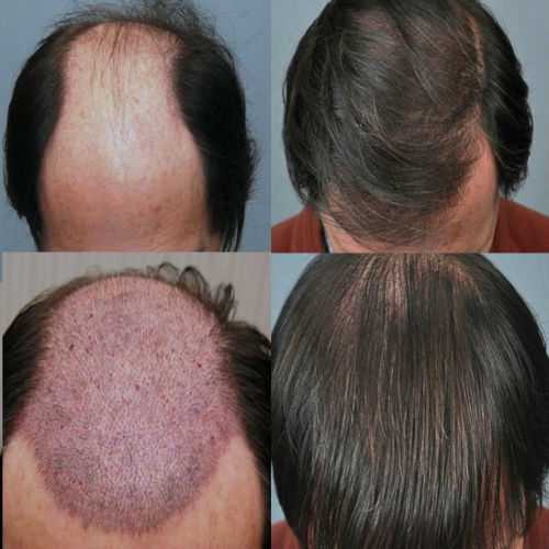 Как быстро вырастают волосы после лазерной эпиляции?