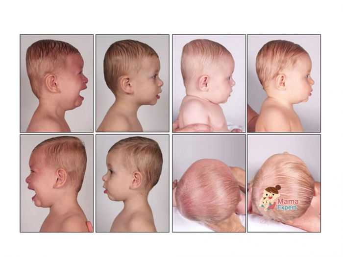 Затылок у ребенка в год. Скафоцефалия+плагиоцефалия. Скафоцефалия затылочная. Плагиоцефалия черепа у детей. Врожденная кривошея-плагиоцефалия.