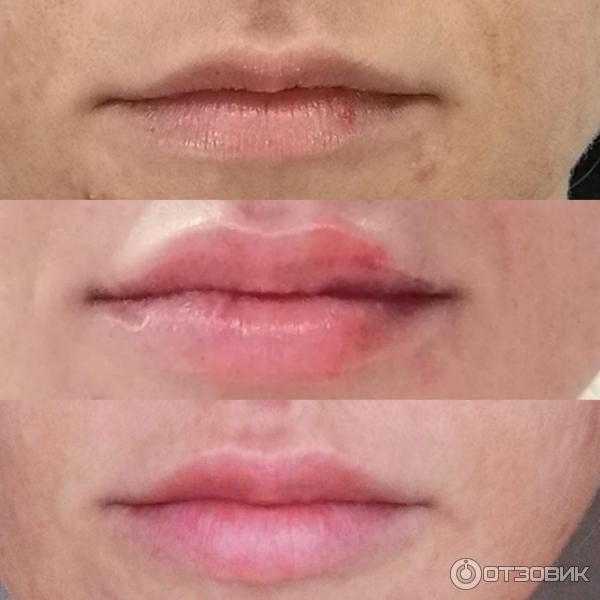 Сколько держится гиалуроновой губах
