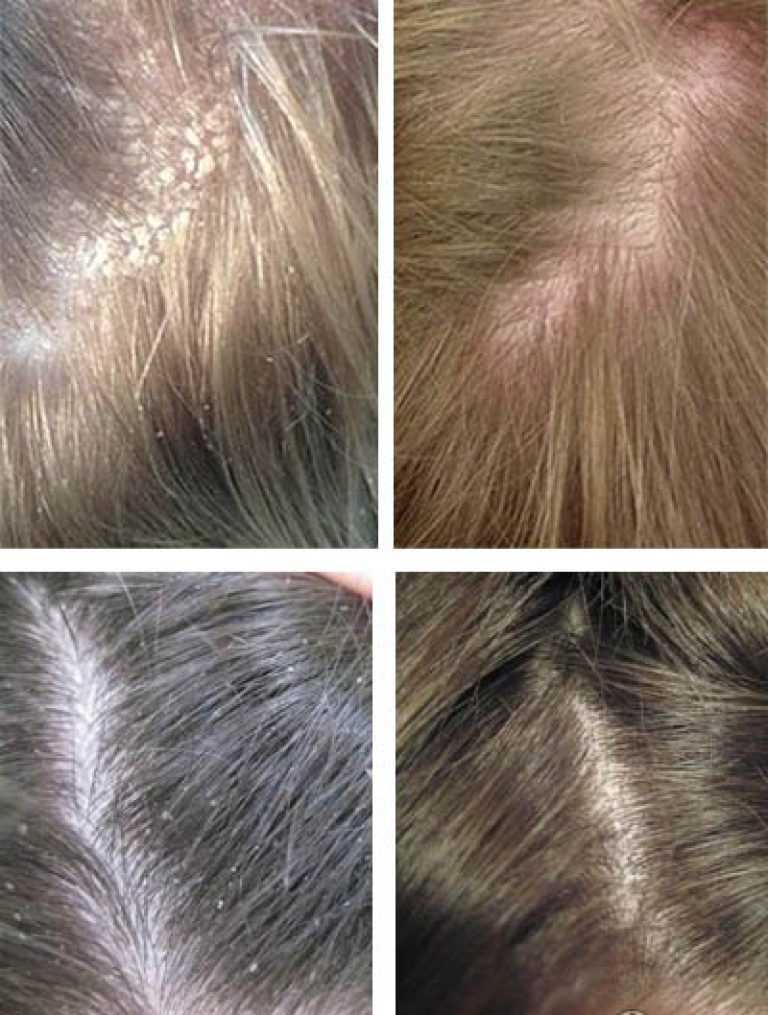 Виды перхоти на голове - клиника «доктор волос»