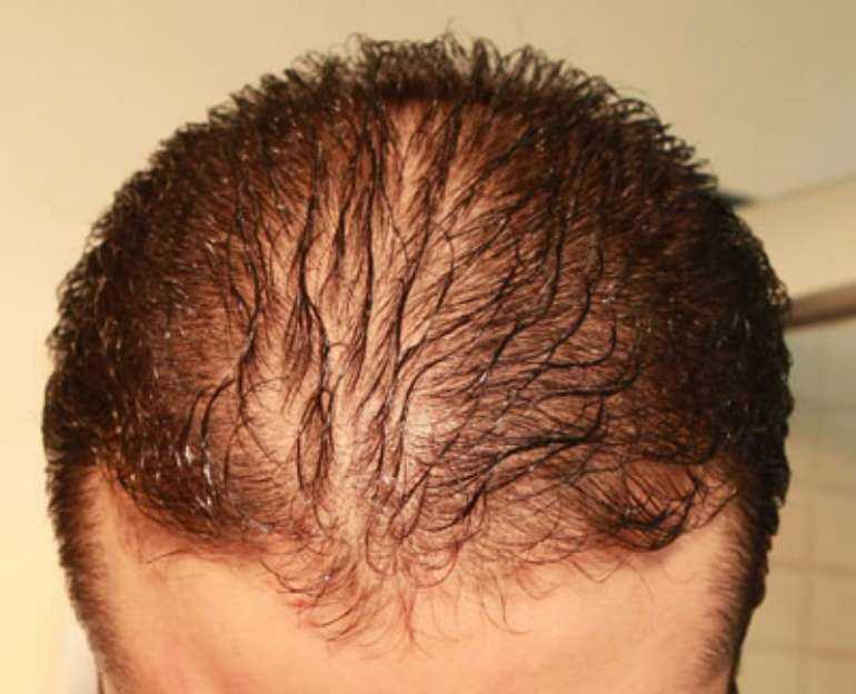 Будет густо: как бороться с выпадением волос