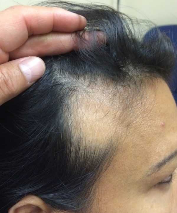Рубцовая алопеция. методы лечения рубцового выпадения волос