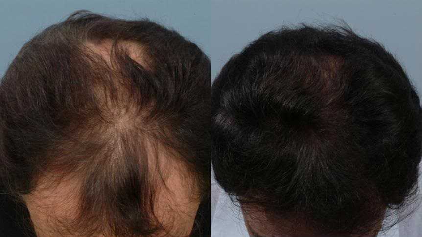 Седые волосы в раннем возрасте (в 16, 20, 25, 30 лет): причины у женщин и мужчин, когда начинают возникать, как бороться, лечение