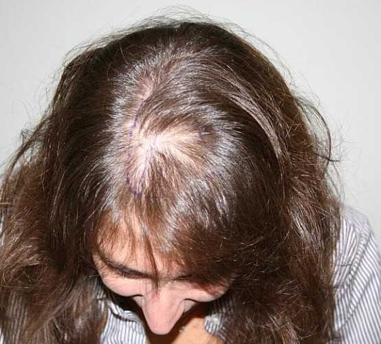 Дигидротестостерон – гормональная причина выпадения волос